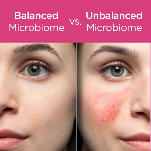 Healthy skin starts with a balanced microbiome